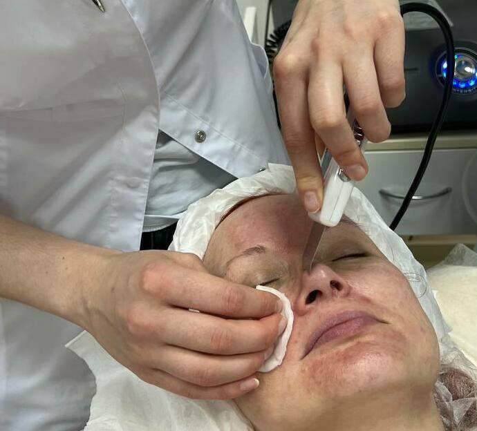 Аппаратная косметология Чистка ультразвуком